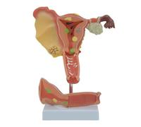 AMITD Modèle utérus pathologique de taille réelle avec pièces amovibles - GYN Teaching & Démo