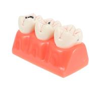 Amosfun Modèle Anatomique Blanche Agrandi Démonstration de Caries et des Dents Outil Pédagogique pour et Éducation Buccale