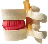 Anatomie buccaleHernie discale lombaire humaineModèle de démonstrationAnatomie de la colonne vertébrale humaineModèle de colonne vertébrale humaineColonne vertébrale humaineColonne lombaireHernie disc