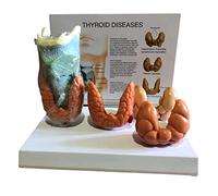 Anatomie humaine Modèle pathologique laryngé et thyroïdien pour l'éducation - Ressources pédagogiques de pathologie normale et maladie
