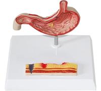 Anatomie Modèle - Ventre humain pour l'éducation médicale, démonstration de gastrite et d'ulcères, outil pédagogique perforé de pathologie
