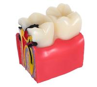 ANDRESLAD Modèle Pédagogique Comparatif de Caries Dentaires Agrandi 6 Fois en Plastique Solide Outil Éducatif pour Enseignants et Étudiants en Anatomie Démonstration Santé Bucco-