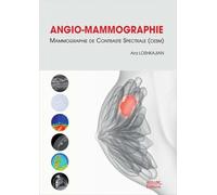 Angio-mammographie: Mammographie de contraste spectrale (CESM)