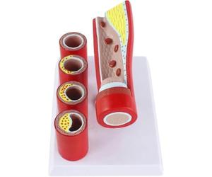 Artère cardiovasculaire Modèle semblable à une artère coronaire Modèle anatomique vasculaire pathologique d'enseignement humain - Modèle de formation de sclérose de l'artère branche âgée Modèle