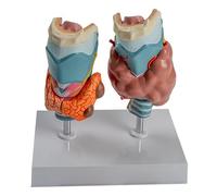 ATJSXWIN Humaine Thyroïdienne Pathologie Modèle 4 Parties, Modèle D'Anatomie Thyroïdienne Montrant Une Tumeur Thyroïdienne, Un Cancer De La Thyroïde, la maladie De Graves