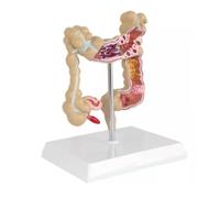 AZHKJKZH Maquette D'Anatomie Modèle De Lésion Colorectale Humaine, Anatomie Pathologique, Maladies du Côlon, L'intestin, Enseignement Médical, Science pour Formation Médicale