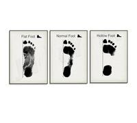 Baibexing Arte Dell'Impronta Del Piede, Patologia Del Piede, Ortopedia, Cura Del Piede Del Podologo, Arte Medica, Poster Decorativo Per Clinica Ortopedica, Dipinto Su Tela 40X60Cmx3Pcs Sans Cadre