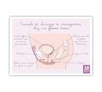 Bivea | Schéma anatomique Réassignation chez une femme trans | Format A5