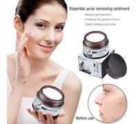 Blanchiment Visage Creme Hydratante Anti Rides Anti Vieillissement Affaiblir Anti Acne Creme Visage Soin De La Peau