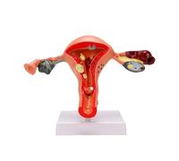 Brrnoo Modèle Anatomique D'ovaire de L'utérus Pathologique Féminin Modèle D'anatomie de L'utérus Humain en PVC pour L'étude de L'éducation Enseignement D'éducation Infirmière