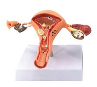 buyzg Modèle d'ovaire d'utérus féminin Pathologie Utérus Humain Maladie d'ovaire Dissection Biologie Aide pédagogique Modèle de lésion d'anatomie
