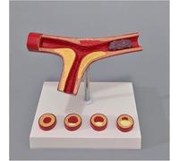 Cadeau médical, modèle d'artère intracrânienne, modèle d'athérosclérose et de thrombose de l'artère humaine, modèle d'artériosclérose cardiovasculaire, for l'anatomie d'étude