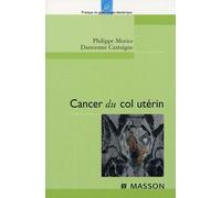 Cancer du col utérin