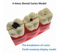 Caries Dentaires Perfectionnées,Modèle De Dent,Apprendre À Étudier,1 Pièce,Taille 4:1