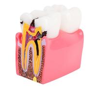 Caries Etude comparative Modèles Dentiste Anatomie dentaire Formation Dents Modèle