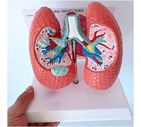 CCKUYT Modèle d'anatomie des Pathologies pulmonaires - Modèle d'anatomie des Organes Humains Modèle de maladie pulmonaire