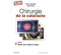 Chirurgie De La Cataracte