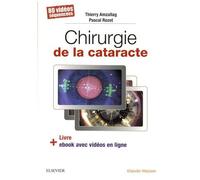 Chirurgie De La Cataracte