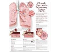 Chronic Obstructive Pulmonary Disease Anatomical Chart