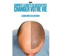 Comment la greffe de cheveux peut changer votre vie : Le guide complet de l'opération