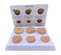 COYEUX Ensemble De 6 Modèles De Lésions Prostatiques, Kit De Démonstration De Lésions Prostatiques avec Socle Et Notice Détaillée, pour Lenseignement De Lurologie Et Les étudiants en Médecine.