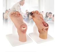 COYEUX Modèle Dulcère du Pied Diabétique À Gradation 2 Pièces, Simulateur De Formation Aux Soins du Pied Diabétique, Démonstration De Soins des Plaies De Gravité Légère (Niveaux 1 À 3) Et Sévère