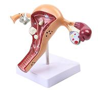 DADAKEWIN Femmes Genitaux Internes Et Externes PVC Modèle Anatomique De L'ovaire Et De La Contraception Utérine Modèle De Guidage (Color : Pathological Uterus Model)