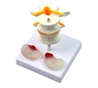 DANNMPX Modèle Humain Modèle Squelettique Anatomique De Intervertébral Malade Colonne Lombaire Humaine Vertébrale Anatomique