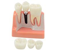 DBMGB Amovible Modèle D'implant, Modèle Dentaire de Pont de Couronne, Modèle de Dent pour Aidant Le Dentiste et Le Patient à Communiquer et à Discuter du Plan de Traitement, Intuitif et Portable