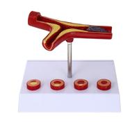 DEARMAMY Modèle Anatomique pour Enseignement Affichage Du Vasculaire Humain avec Thrombose Modèle de Structure Artérielle Pathologique pour Étudiants et Professionnels