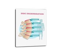 Degenerative Disc Disease Educational Poster 3 Stages of Spinal Conditions Medical Illustration Anatomy Wall Art for Healthcare Professionals Decor(Unframed,12X18inch(30X45cm))
