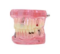 Dentalmall 1 PC Dental Implant Étude Analyse des dents de démonstration Modèle # 2001 avec la restauration Rose