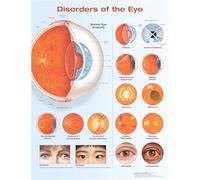 Disorders of the Eye Anatomical Chart