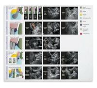 Endometriosis Sonography Reference Poster Ultrasound Imaging of Pelvic Lesions Diagnosis Guide(Framed,08x12inch(20x30cm))