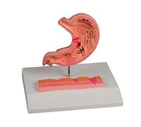 Erler Zimmer Estomac avec ulcère gastrique Modèle anatomique Inflammation de l'estomac Ulcère gastrique
