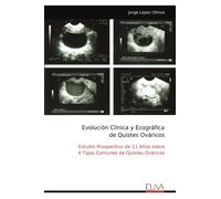 Evolución Clínica y Ecográfica de Quistes Ováricos: Estudio Prospectivo de 11 Años sobre 4 Tipos Comunes de Quistes Ováricos