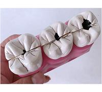 FHUILI Pathologies Modèle Dents - Dech Decay Anatomie Modèle - Modèle d'enseignement des Dents Modèle pathologique Caries dentaires dans Le modèle Dents Malades - pour du Démo d'enseignement,A