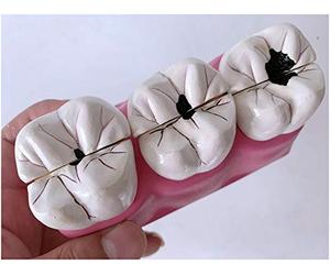 FHUILI Pathologies Modèle Dents - Dech Decay Anatomie Modèle - Modèle d'enseignement des Dents Modèle pathologique Caries dentaires dans Le modèle Dents Malades - pour du Démo d'enseignement,A