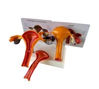 FHUILIJH A,Life Size, Modèle d'anatomie pathologique utérine Modèle Anatomique reproductif de l'ovaire Modifications pathologiques de l'utérus Modèle Scientifique d'enseignement