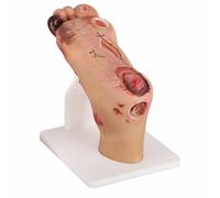 FHUILIJH Modèle de Soins du Pied diabétique, modèle de pathologie du Pied, modèle d'ulcère du Pied médical pour l'aide à l'enseignement des déformations du Pied,Severe,15cm