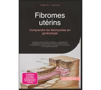 Fibromes utérins: Comprendre les léiomyomes en gynécologie