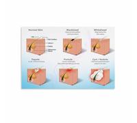 FQHIDMOMX Skin Care Education Poster Acne Face Mapping Chart for Beauty Salon and Home Use(Framed,08x12inch(20x30cm))