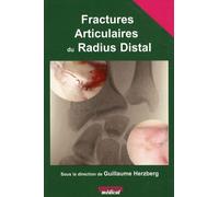 Fractures Articulaires Du Radius Distal