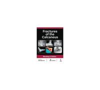 Fractures Of The Calcaneus