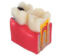 FUNOMOCYA Modèle Pédagogique de Dents Cariées 6x Agrandi, Outil Éducatif pour Dentistes et Étudiants, Démonstration Anatomique Réaliste, Matériel Didactique D’éducation Carie, Usage