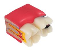 Garneck Modèle Pédagogique Agrandi 6 Fois pour Comparaison des Caries, Modèle Anatomique Éducatif pour Étudiants et Patients, Outil D’Enseignement Bucco- Professionnel