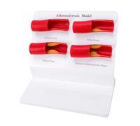 Generic Modèle D'athérosclérose, Affichage Anatomique Précis des Blocages Artériels, Conception D'entretien Facile pour les Environnements Cliniques