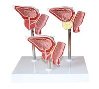 Générique Modèle anatomique humain de prostate - 1 : 1 modèle de prostate à taille réelle en matériau PVC, représentation normale et blessée, modèles de science de l'anatomie humaine.