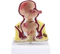 Générique Modèle de Rectum - Modèle Pathologique d'Ulcer Rectal Acne - Modèle Anatomique du Système Digestif Humain pour Aide à la Formation Éducative
