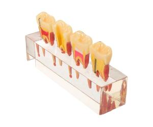 Générique Modèle Dentaire Pédagogique en Résine Visualisation Progression des Caries pour Dents Primaires Support de Communication en Consultation et Salle de Classe